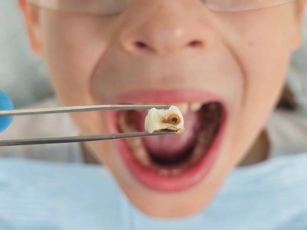 Best Broken or Cracked Tooth Emergency Dentist in Trinidad, CO