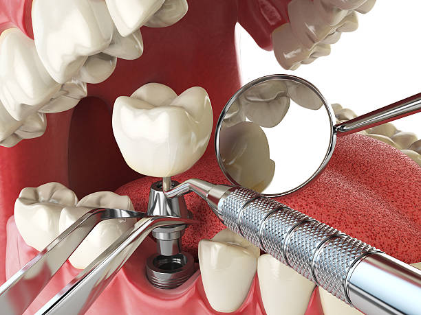 Best Broken or Cracked Tooth Emergency Dentist in Trinidad, CO